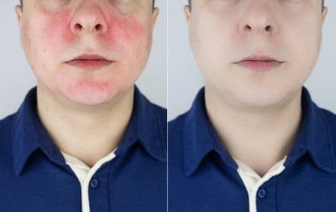 Rosacea face. The man suffers from redness on her cheeks. Couperose of the skin. Redness and capillary mesh are visible on the face. Treatment and removal. Vascular surgery and dermatology