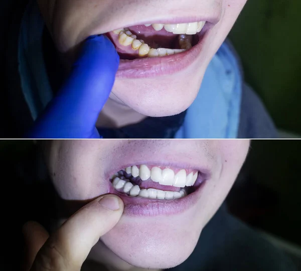 Tartar removal. Before and after the procedure for cleaning the tooth enamel from plaque and yellowness. Deposition of microbial life products on the roots of the tooth.