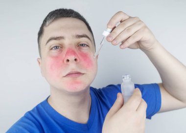 Azelaik asit. Adam yüzüne azelainat uyguluyor. Laboratuvar araştırması. Yüz bakımı. Dermatolojik serum. Rosacea, sivilce ve deri sorunlarının tedavisi için emülsiyon