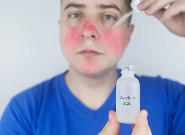 アゼライン酸だ 男は彼女の顔にツツジを適用します 研究室の研究 顔の皮膚ケア 皮膚科の血清 酒さの治療のための乳化 にきびと皮膚の問題 — ストック写真