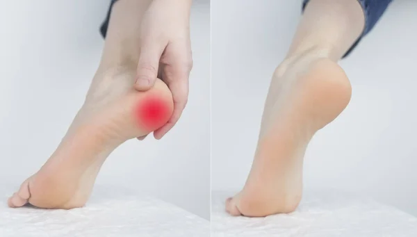 之前和之后 脚后跟疼痛的女人脚腱发炎或扭伤 脚后跟刺激 毛囊炎 关于腿部疾病和疼痛的概念 右图无痛 — 图库照片