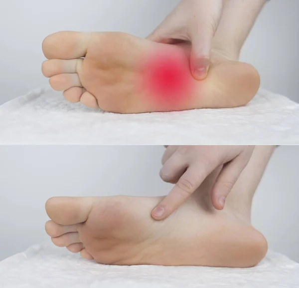 之前和之后 足部疼痛 肌腱扭伤 扁平脚 毛囊炎 筋膜炎 疾病治疗概念 在左边 她发现了一个伤口 在右边 — 图库照片