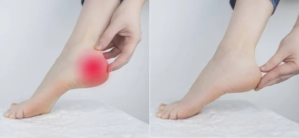 Önce Sonra Topuk Ağrısı Çeken Bir Kadın Ayağındaki Tendonun Iltihaplanması — Stok fotoğraf
