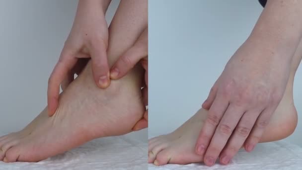 之前和之后 足部疼痛 肌腱扭伤 扁平脚 毛囊炎 筋膜炎 跟腱和脚后跟疼痛 在左边 她发现了一个伤口 在右边 — 图库视频影像