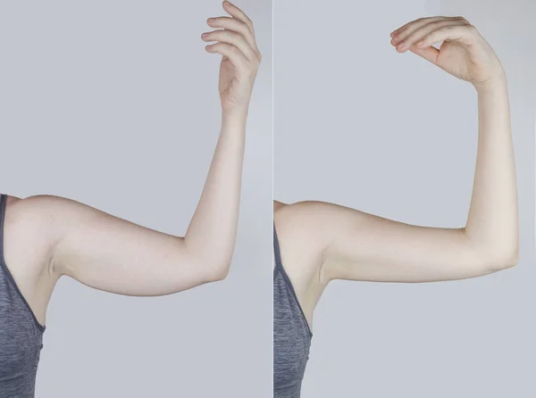 Ожиріння Целюліт Провисання Білої Шкіри Жіночій Руці Після Концепція Схуднення Стокове Зображення