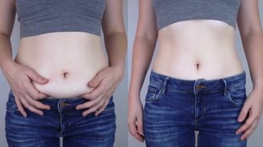 Obezite selüliti. Kadın belinde aşırı yağ kıvrımları. Önce ve sonra. Kilo verme, spor yapma, diyet ve yoğun eğitimin sonuçlarını kontrol etme kavramı. Kilo vermenin sonucu. Yağ aldırma