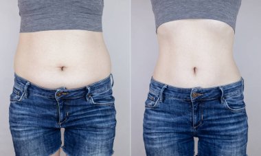 Obezite selüliti. Kadın belinde aşırı yağ kıvrımları. Önce ve sonra. Kilo verme, spor yapma, diyet ve yoğun eğitimin sonuçlarını kontrol etme kavramı. Kilo vermenin sonucu. Yağ aldırma