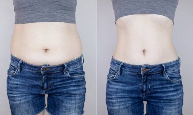 Obesity Cellulite. Folds of excess fat on woman waist. Before and after. Concept of losing weight, playing sports, checking result from diet and intense training. Result of losing weight. Liposuction clipart