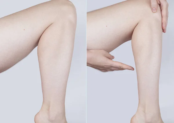 Obesity Cellulite. Sagging flabby skin on woman leg fat. Before and after. Concept losing weight, playing sports, checking result from diet and intense training. Result of losing weight. Liposuction