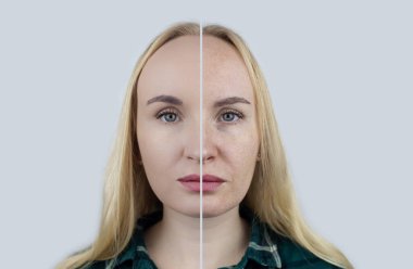 A vitamini, Retinol, Niacinamide, C vitamini kız yüzüne antioksidan kırışıklık önleyici krem sürüyor. Yaşlanma önleyici ve yüz tazeleme ajanı. Önce ve sonra. Görsel sonuç. Sivilce tedavisi