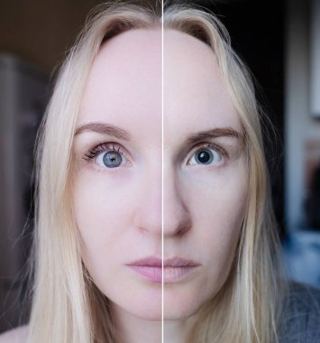 Göz damlası düşmeden önce ve sonra mantarı incelemek için, göz bebeği büyümesi. Bir doktor midriazi ve konaklama spazmı olan bir kadına göz muayenesi yapar. Zayıf görme ve göz kaslarında felç