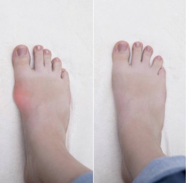 Hallux valgus, baş parmağında deformasyon. Ortopedik doktor ayağındaki kemiği inceler, ayak patolojisini teşhis eder.