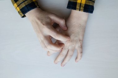 Ellerinde kuru deri var. Kabuğu soyulmuş, erozyonu ve çatlağı olan kadınların elleri. Cilt dermatolojik hastalıklar için krem