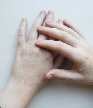 Ellerinde kuru deri var. Kabuğu soyulmuş, erozyonu ve çatlağı olan kadınların elleri. Cilt dermatolojik hastalıklar için krem