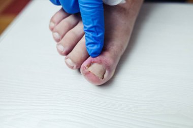 Parmak enfeksiyonu. Paronychia, onychomycosis, tırnak sedef, boylamasına melanonychia, onychomadesis ve retronychia. Baş parmağında iltihap var. Zehirli hastalıkların tedavisi.