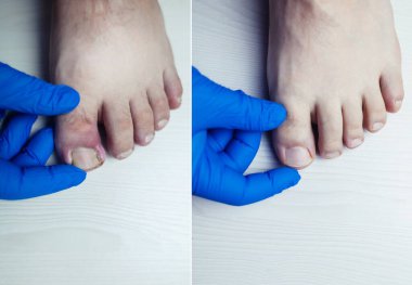 Önce ve sonra. Parmak enfeksiyonu. Paronychia, onychomycosis, tırnak sedef, boylamasına melanonychia, onychomadesis ve retronychia. Baş parmağında iltihap var. Zehirli hastalıkların tedavisi.