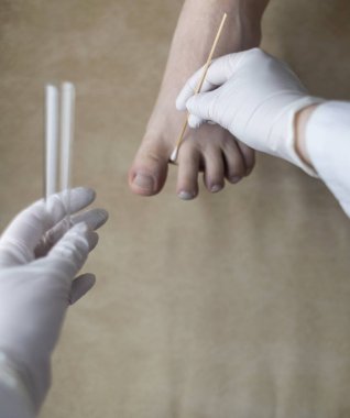 Dermatolog, hastanın bacağından örnek almak için pamuk çubuğu ve test tüpü kullanıyor. Mantar enfeksiyonu teşhisi, mantar ve mikrobiyolojik muayeneler