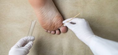 Dermatolog, hastanın bacağından örnek almak için pamuk çubuğu ve test tüpü kullanıyor. Mantar enfeksiyonu teşhisi, mantar ve mikrobiyolojik muayeneler
