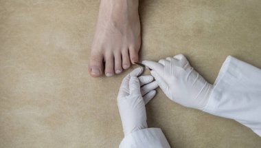 Bir ayak hastalıkları uzmanı mantar enfeksiyonunu incelemek için tırnağından örnek alır. Mikrobiyolojik inceleme, tırnak hastalığının tedavisi için örnek alma.