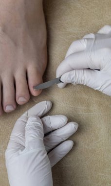 Bir ayak hastalıkları uzmanı mantar enfeksiyonunu incelemek için tırnağından örnek alır. Mikrobiyolojik inceleme, tırnak hastalığının tedavisi için örnek alma.