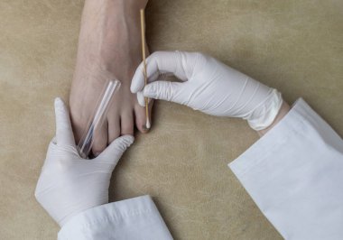 Dermatolog, hastanın bacağından örnek almak için pamuk çubuğu ve test tüpü kullanıyor. Mantar enfeksiyonu teşhisi, mantar ve mikrobiyolojik muayeneler