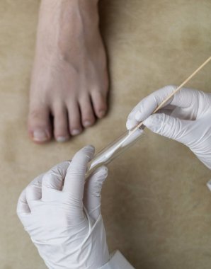 Dermatolog, hastanın bacağından örnek almak için pamuk çubuğu ve test tüpü kullanıyor. Mantar enfeksiyonu teşhisi, mantar ve mikrobiyolojik muayeneler