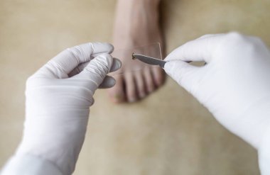 Bir ayak hastalıkları uzmanı mantar enfeksiyonunu incelemek için tırnağından örnek alır. Mikrobiyolojik inceleme, tırnak hastalığının tedavisi için örnek alma.