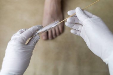 Dermatolog, hastanın bacağından örnek almak için pamuk çubuğu ve test tüpü kullanıyor. Mantar enfeksiyonu teşhisi, mantar ve mikrobiyolojik muayeneler