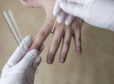 Dermatolog, pamuk çubuğu ve test tüpü kullanarak hastanın kolundan deri örneği topluyor. Mikrobiyolojik analiz. Deri hastalıklarının, mantarların ve enfeksiyonların teşhisi