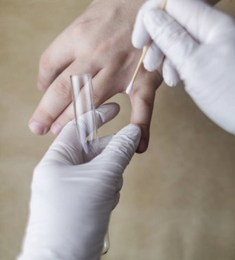 Dermatolog, pamuk çubuğu ve test tüpü kullanarak hastanın kolundan deri örneği topluyor. Mikrobiyolojik analiz. Deri hastalıklarının, mantarların ve enfeksiyonların teşhisi