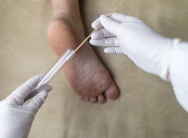 Dermatolog, hastanın bacağından örnek almak için pamuk çubuğu ve test tüpü kullanıyor. Mantar enfeksiyonu teşhisi, mantar ve mikrobiyolojik muayeneler