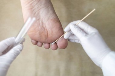 Dermatolog, hastanın bacağından örnek almak için pamuk çubuğu ve test tüpü kullanıyor. Mantar enfeksiyonu teşhisi, mantar ve mikrobiyolojik muayeneler
