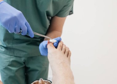 Tırnak kapağının çıkarılması, oyulmuş çivinin çıkarılması. Ameliyattan sonra ayak parmağından giyinmek. Onychocryptosis, paronychia ve irin hastalıklarının cerrahi tedavisi