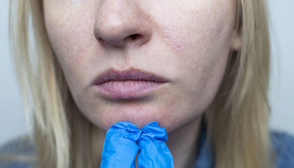 Дерматолог исследует лицо женщины с расширенными порами, пигментацией и сальными нитями. Лечение розацеа и воспаления кожи.