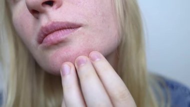 Bir dermatolog, genişlemiş gözenekleri, pigmentasyonu ve yağlı lifleri olan bir kadının yüzünü inceler. Rosacea tedavisi ve cilt iltihabı.