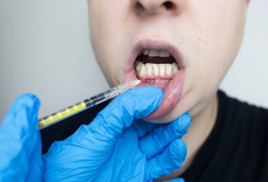 Diş eti resesyonu tedavisi için diş enjeksiyonu. Diş köküne ve sakız tedavisine maruz kalmış. Yenilenme terapisi