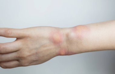 Görünür kızarıklık, iltihap ve böcek ısırığı ya da alerjik reaksiyondan kaynaklanan deri tahrişi olan şişmiş bir bileğin yakın çekimi. Ellerinde kızarıklık, kaşıntı ve yerel acı belirtileri var. Sivrisinek ısırığı, arı sokması ya da böcek ısırığı gibi..