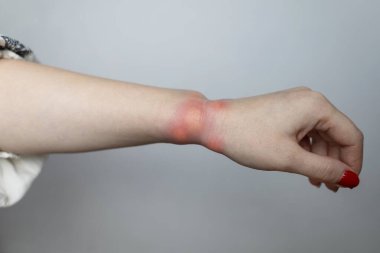 Görünür kızarıklık, iltihap ve böcek ısırığı ya da alerjik reaksiyondan kaynaklanan deri tahrişi olan şişmiş bir bileğin yakın çekimi. Ellerinde kızarıklık, kaşıntı ve yerel acı belirtileri var. Sivrisinek ısırığı, arı sokması ya da böcek ısırığı gibi..