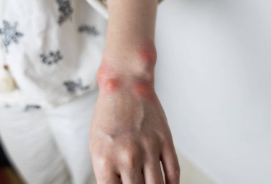Görünür kızarıklık, iltihap ve böcek ısırığı ya da alerjik reaksiyondan kaynaklanan deri tahrişi olan şişmiş bir bileğin yakın çekimi. Ellerinde kızarıklık, kaşıntı ve yerel acı belirtileri var. Sivrisinek ısırığı, arı sokması ya da böcek ısırığı gibi..