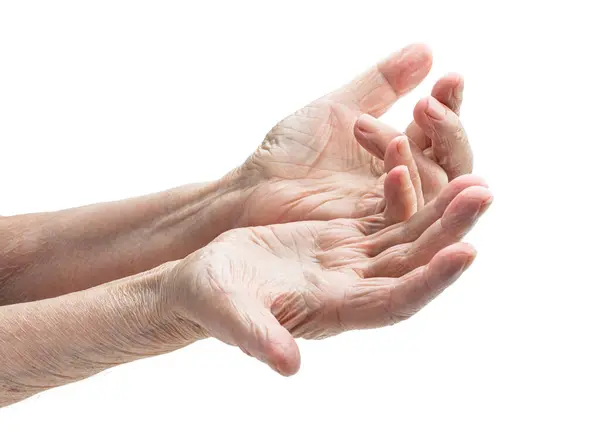 Χέρια Μιας Ηλικιωμένης Γυναίκας Νόσο Του Dupuytren Εικόνα Αρχείου