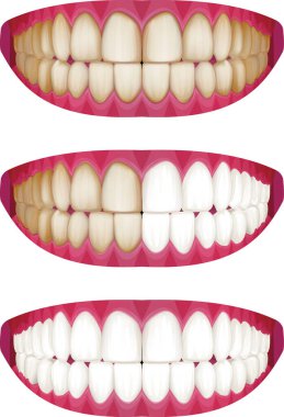 Güzel beyaz dişler ve lekeli dişler.