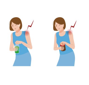 Donmuş omuz, omuz eklem iltihabı. Kapağı açamayan omuz ağrısı olan bir kadın..