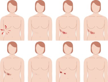 Zona belirtileri var. Ön taraftan bir kadının üst vücudu görünüyor..