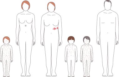 Zona ve suçiçeği. Çocuk ve yetişkinlerdeki semptomların çizimi