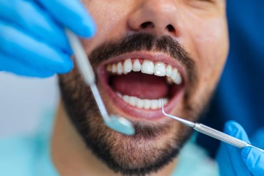 Modern diş sağlığı kliniğinde diş kontrolü sırasında ağzı açık bir adamın yakın çekimi. Oral sağlık ve diş bakımına odaklanın.