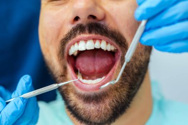 Modern diş sağlığı kliniğinde diş kontrolü sırasında ağzı açık bir adamın yakın çekimi. Oral sağlık ve diş bakımına odaklanın.