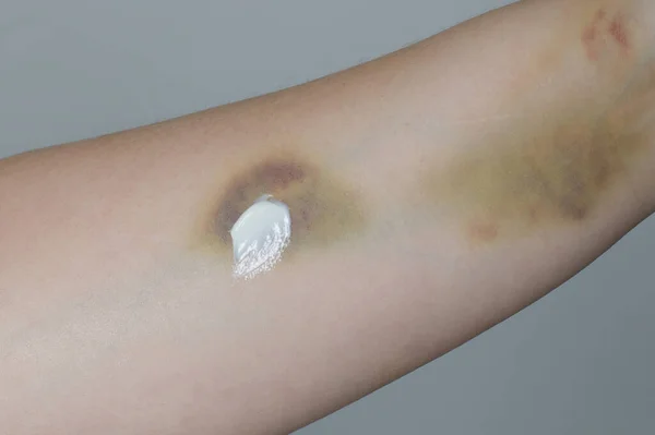 Medical ointment or cream on skin closeup