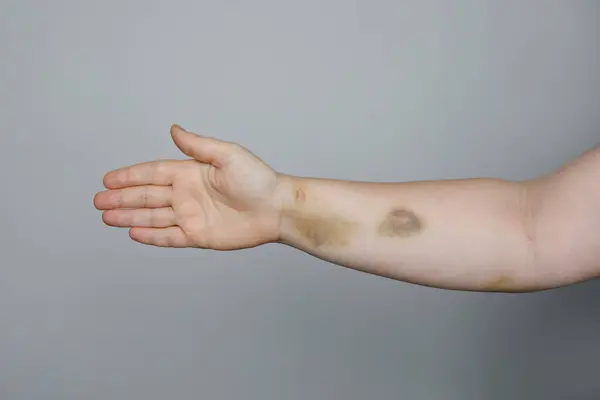 Large bruise on human arm. Injection bruises.