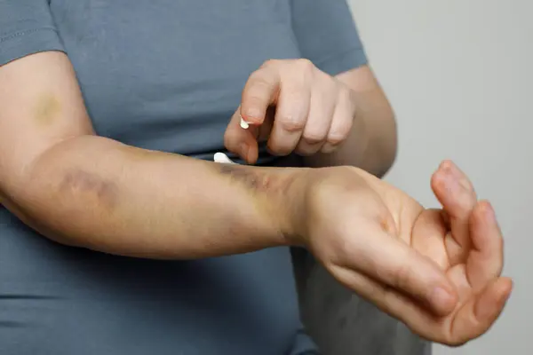 Mulher Esfrega Mão Com Uma Pomada Dor Creme Mão Contra — Fotografia de Stock