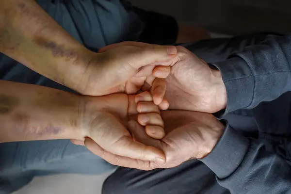 Menschliche Hand Mit Blauen Flecken Der Anderen Menschlichen Hand Unterstützung lizenzfreie Stockfotos